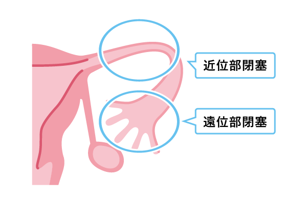 卵管閉塞の位置